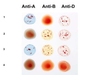 Anti-A Anti-B Anti-D
1
2
3
4
 