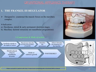 Complex Sheilds Comprehensive Management of Class III Malocclusion in Orthodontics | PDF