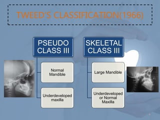 Comprehensive Management of Class III Malocclusion in Orthodontics | PDF