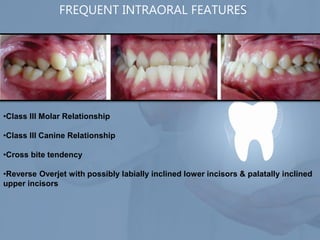 Xbite Tendency Comprehensive Management of Class III Malocclusion in Orthodontics | PDF