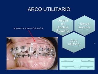 ARCO UTILITARIO
Sector
Anterior
Unidad
de
Anclaje
Posterior
Arco
utilitario
ALAMBRE DE ACERO 0.016 X 0.016
 