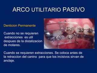 ARCO UTILITARIO PASIVO
Denticion Permanente
Cuando no se requieren
extracciones es util
despues de la distalizacion
de molares.
Cuando se requieren extracciones. Se coloca antes de
la retraccion del canino para que los incisivos sirvan de
anclaje.
 