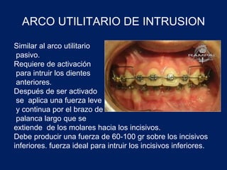 ARCO UTILITARIO DE INTRUSION
Similar al arco utilitario
pasivo.
Requiere de activación
para intruir los dientes
anteriores.
Después de ser activado
se aplica una fuerza leve
y continua por el brazo de
palanca largo que se
extiende de los molares hacia los incisivos.
Debe producir una fuerza de 60-100 gr sobre los incisivos
inferiores. fuerza ideal para intruir los incisivos inferiores.
 