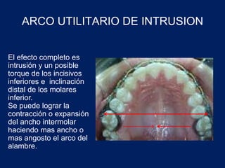 ARCO UTILITARIO DE INTRUSION
El efecto completo es
intrusión y un posible
torque de los incisivos
inferiores e inclinación
distal de los molares
inferior.
Se puede lograr la
contracción o expansión
del ancho intermolar
haciendo mas ancho o
mas angosto el arco del
alambre.
 