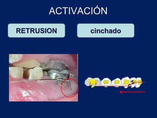 ACTIVACIÓN
RETRUSION cinchado
 