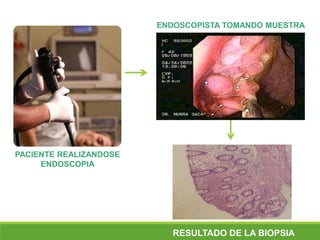 PACIENTE REALIZANDOSE
ENDOSCOPIA
RESULTADO DE LA BIOPSIA
ENDOSCOPISTA TOMANDO MUESTRA
 