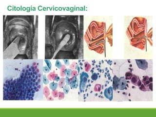 Citología Cervicovaginal:
 