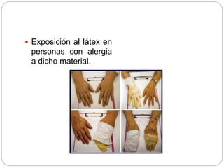  Exposición al látex en
personas con alergia
a dicho material.
 