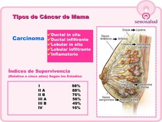 Tipos de Cáncer de Mama Carcinoma Ductal in situ Ductal infiltrante Lobular in situ Lobular infiltrante Inflamatorio Índices de Supervivencia   (Relativa a cinco años) Según los Estadios   I  98% II A  88% II B  76% III A  56% III B  49% IV  16% Índices de Supervivencia   (Relativa a cinco años) Según los Estadios   I  98% II A  88% II B  76% III A  56% III B  49% IV  16% 