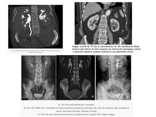 429475901-pielonefritis-convertido-pptx.pptx