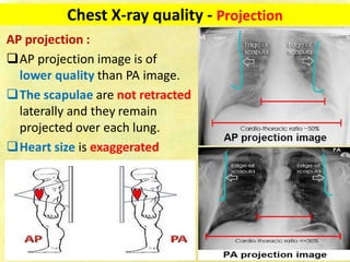 Chest x ray-fundamentals | PDF
