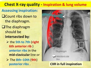 Inspiration Normal Ribs Chest x ray-fundamentals | PDF