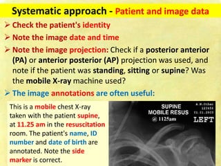 Chest x ray-fundamentals | PDF