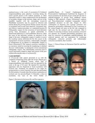 Prathigudupu RS et al. Facial Asymmetry Post TMJ Ankylosis.
42
Journal of Advanced Medical and Dental Sciences Research |Vol. 6|Issue 7| July 2018
unattractiveness is the result of asymmetry.[3] Unilateral
temporomandibular joint ankylosis occurring during the
active growth period if left without treatment, or when
improperly treated, is often complicated by the development
of secondary changes in the structure, shape, and size of the
mandible together with the surrounding tissues.[4]
Mandibular asymmetry may be caused by infection and
trauma during the growing period. Primary trauma may lead
to asymmetry and in some cases ankylosis. Asymmetry may
also follow a surgical procedure or a malunited fracture.[5]
Orthognathic surgery for the correction of facial deformity
arising from discrepancy in spatial relationship or
dimensional differences is well established. However, when
the cause of the deformity includes an alteration of the
shape of the jaws, orthognathic surgery is unable to correct
the resulting contour deformity.[6] For this reason in the
management of facial asymmetry, orthomorphic principles
of management are an adjunct to orthognathic surgery or
Osseo distraction.[7] The surgical correction consisting of
an osteotomy aimed at restoring the morphology is denoted
the term “orthomorphic” to distinguish it from conventional
orthognathic surgery. The orthomorphic correction aims to
correct deformities related to shape and contour of the jaws
without affecting the status of occlusion.[6]
CASE REPORT:
A 23-year-old male patient presented to us with the
complaint of flattening of the right side of face. Patient gave
a history of childhood trauma which lead to
temporomandibular joint ankylosis and was operated for the
same at the age of 10 years. He reported for unaesthetic
appearance and was diagnosed as facial asymmetry with
occlusal cant. Treatment was planned in two stages by
giving priority to correct function first and then proceeding
for the aesthetics 6 months later.On occlusal examination an
occlusal cant was present.(Figure 1) Clinically a clear-cut
asymmetry was seen in the lower border of
mandible.(Figure 2) Lateral Cephalogram and
Posteroanterior Cephalogram Confirmed the diagnosis of
facial asymmetry by deviation of jaw on the left side due to
underdevelopment of growth from childhood trauma
leading to TMJ ankylosis. (Figure 3)Grumman’s analysis
and Three-dimensional computed tomography elicited
mandibular deviation on left side. (Figure 4). After
confirmation of diagnosis first occlusal correction was
planned by performing a differential Le Fort I osteotomy as
the vertical height was more on the left side compared to
right side. So, the occlusal cant was corrected. After 6
months of correcting occlusion, facial asymmetry correction
was planned. An extended lateralsliding genioplasty was
done for correction of mandibular underdevelopment. We
achieved patients and our expectation by combining
orthognathic correction primarily and orthomorphic
correction secondarily after 6 months.
Figure 1: Clinical Picture & Occlusion Cant Pre and Post-
operative.
Figure 2: Deviation & Occlusion Pre and Post-operative.
 