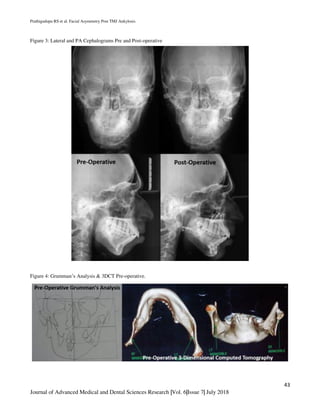 Prathigudupu RS et al. Facial Asymmetry Post TMJ Ankylosis.
43
Journal of Advanced Medical and Dental Sciences Research |Vol. 6|Issue 7| July 2018
Figure 3: Lateral and PA Cephalograms Pre and Post-operative
Figure 4: Grumman’s Analysis & 3DCT Pre-operative.
 