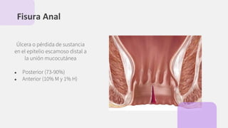 Úlcera o pérdida de sustancia
en el epitelio escamoso distal a
la unión mucocutánea
● Posterior (73-90%)
● Anterior (10% M y 1% H)
Fisura Anal
 