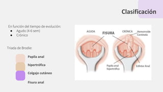 Clasificación
En función del tiempo de evolución:
● Agudo (4-6 sem)
● Crónico
Triada de Brodie:
Papila anal
hipertrófica
Colgajo cutáneo
Fisura anal
 