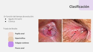 Clasificación
En función del tiempo de evolución:
● Agudo (4-6 sem)
● Crónica
Triada de Brodie:
Papila anal
hipertrófica
Colgajo cutáneo
Fisura anal
 