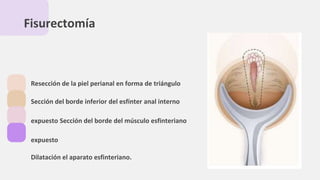 Fisurectomía
Resección de la piel perianal en forma de triángulo
Sección del borde inferior del esfínter anal interno
expuesto Sección del borde del músculo esfinteriano
expuesto
Dilatación el aparato esfinteriano.
 