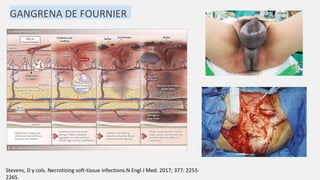 Stevens, D y cols. Necrotizing soft-tissue infections.N Engl J Med. 2017; 377: 2253-
2265.
GANGRENA DE FOURNIER
 