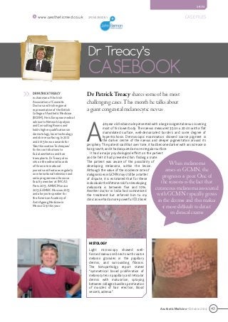 43
CASE FILES
Aesthetic Medicine • October 2014
S K I N
www.aestheticmed.co.uk
Dr Patrick Treacy shares some of his most
challenging cases. This month he talks about
a giant congenital melanocytic nevus
Dr Treacy’s
CASEBOOK
DR PATRICK TREACY
is chairman of the Irish
Association of Cosmetic
Doctors and Irish regional
representative of the British
College of Aesthetic Medicine
(BCAM). He is European medical
advisor to Network Lipolysis
and Consulting Rooms and
holds higher qualifications in
dermatology, laser technology
and skin resurfacing. In 2012
and 2013 he won awards for
‘Best Innovative Techniques’
for his contributions to
facial aesthetics and hair
transplants. Dr Treacy also
sits on the editorial boards
of three international
journals and features regularly
on international television and
radio programmes. He was a
faculty member at IMCAS
Paris 2013, AMWC Monaco
2013, EAMWC Moscow 2013
and a keynote speaker for
the American Academy of
Anti-Ageing Medicine in
Mexico City this year.
>>
SPONSORED BY
A
40 year old Indian male presented with a large congenital nevus covering
most of his lower body. The naevus measured 35 cm x 20 cm with a flat
mammilated surface, well-demarcated borders and some degree of
hypertrichosis. Dermoscopic examination showed coarse pigment in
the darker centre of the naevus and deeper pigmentation around its
periphery. The patient said that over time, it had become darker with an increase in
hair growth, and it had acquired a more irregular surface.
It had a major psychological effect on the patient
and he felt it had prevented him finding a mate.
The patient was aware of the possibility of
developing melanoma, within the lesion.
Although the value of the incidence rate of
malignancies in GCMN may still be a matter
of dispute, it is estimated that for these
individualsthelifetimeriskfordeveloping
melanoma is between five and 10%.
Another doctor in India had commenced
the treatment but referred him to my
clinic as we had a more powerful CO2 laser.
When melanoma
arises in GCMN, the
prognosis is poor. One of
the reasons is the fact that
cutaneous melanoma associated
with GCMN typically grows
in the dermis and this makes
it more difficult to detect
in clinical exams
HISTOLOGY
Light microscopy showed well-
formed naevus cell nests with coarse
melanin granules in the papillary
dermis, and surrounding fibrosis.
The histopatholgy report stated
“symmetrical broad proliferation of
melanocytes in papillary and reticular
dermis with maturation, splaying
between collagen bundles, permeation
of muscles of hair erection, blood
vessels, adnexa”.
 