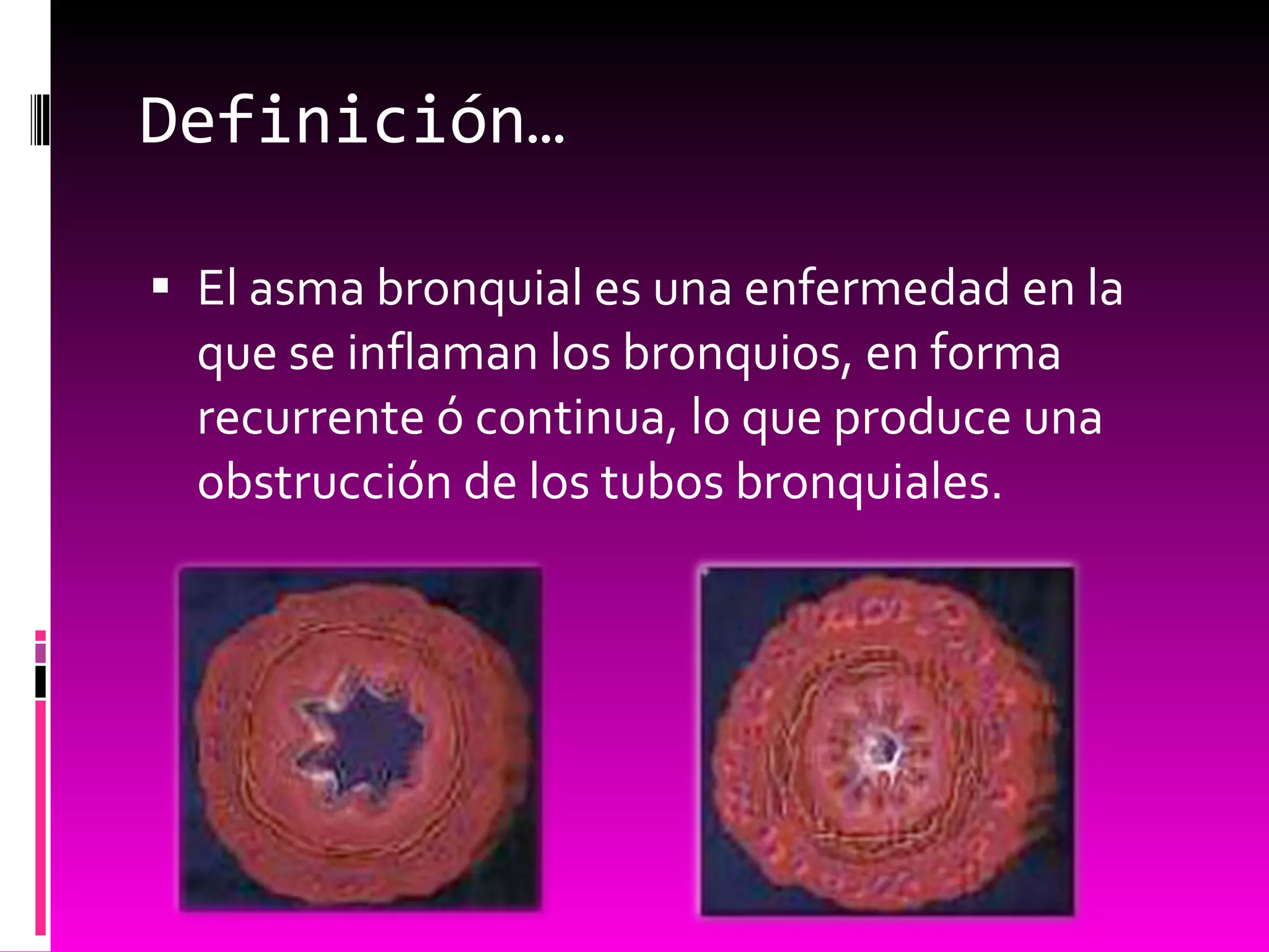 43 asma bronquial | PPT | Lung and Respiratory Health | Diseases and Conditions