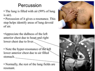 Percussion
• The lung is filled with air (99% of lung
is air).
• Percussion of it gives a resonance. This
step helps identify areas of lung devoid
of air.
•Appreciate the dullness of the left
anterior chest due to heart and right
lower chest due to liver.
• Note the hyper-resonance of the left
lower anterior chest due to air filled
stomach.
• Normally, the rest of the lung fields are
resonant.
 
