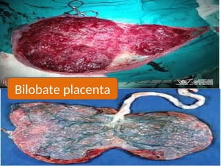 Bilobate placenta
 