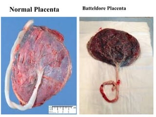Normal Placenta Batteldore Placenta
 