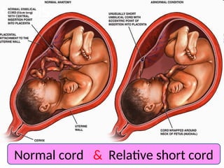 Normal cord & Relative short cord
 