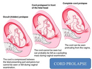 CORD PROLAPSE
 