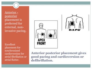 Anterior posterior placement gives
good pacing and cardioversion or
defibrillation.
Anterior -
posterior
placement is
preferred for
external, non-
invasive pacing.
Excellent
placement for
synchronized
cardioversion for
atrial fibrillation or
atrial flutter.
 