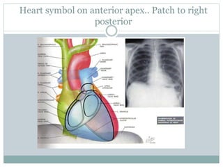 Heart symbol on anterior apex.. Patch to right
posterior
 