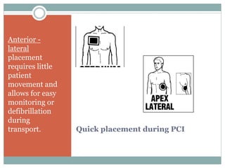 Quick placement during PCI
Anterior -
lateral
placement
requires little
patient
movement and
allows for easy
monitoring or
defibrillation
during
transport.
 