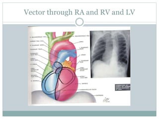 Vector through RA and RV and LV
 