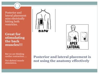 Posterior and lateral placement is
not using the anatomy effectively
Posterior and
lateral placement
miss electrically
hitting both
ventricles.
Great for
stimulating
the back
muscles!!!
But we are thinking
cardiac contraction…..
Not skeletal muscle
stimulation.
 