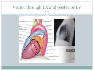 Vector through LA and posterior LV
 