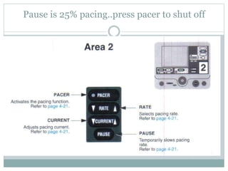 Pause is 25% pacing..press pacer to shut off
 