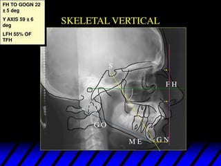 432371195 lateral cephalo metry anlysis .pdf