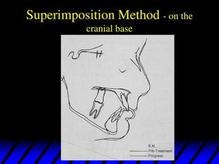 432371195 lateral cephalo metry anlysis .pdf