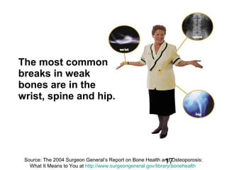 17
The most common
breaks in weak
bones are in the
wrist, spine and hip.
Source: The 2004 Surgeon General’s Report on Bone Health and Osteoporosis:
What It Means to You at http://www.surgeongeneral.gov/library/bonehealth
 