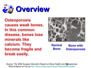 9
OverviewOverview
Bone with
Osteoporosis
Normal
Bone
Osteoporosis
causes weak bones.
In this common
disease, bones lose
minerals like
calcium. They
become fragile and
break easily.
Source: The 2004 Surgeon General’s Report on Bone Health and Osteoporosis:
What It Means to You at http://www.surgeongeneral.gov/library/bonehealth
 