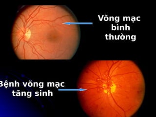 Võng mạc
Võng mạc
bình
bình
thường
thường
Bệnh võng mạc
Bệnh võng mạc
tăng sinh
tăng sinh
4360515
 