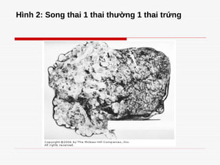Hình 2: Song thai 1 thai thường 1 thai trứng
 