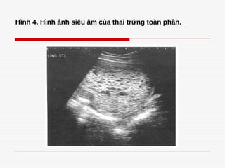 Hình 4. Hình ảnh siêu âm của thai trứng toàn phần.
 