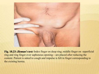 Fig. 18.23: Zieman’s test: Index finger on deep ring; middle finger on superficial
ring and ring finger over saphenous opening—are placed after reducing the
content. Patient is asked to cough and impulse is felt in finger corresponding to
the existing hernia.
 