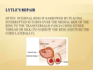 LYTLE’S REPAIR
OFTEN INTERNAL RING IS NARROWED BY PLACING
INTERRUPTED SUTURES OVER THE MEDIAL SIDE OF THE
RING TO THE TRANSVERSALIS FASCIA USING EITHER
THREAD OR SILK (TO NARROW THE RING AND PUSH THE
CORD LATERALLY).
 