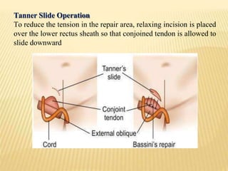 Tanner Slide Operation
To reduce the tension in the repair area, relaxing incision is placed
over the lower rectus sheath so that conjoined tendon is allowed to
slide downward
 