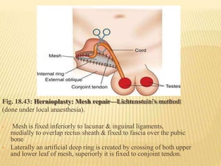 Fig. 18.43: Hernioplasty: Mesh repair—Lichtenstein’s method
(done under local anaesthesia).
 Mesh is fixed inferiorly to lacunar & inguinal ligaments,
medially to overlap rectus sheath & fixed to fascia over the pubic
bone
 Laterally an artificial deep ring is created by crossing of both upper
and lower leaf of mesh, superiorly it is fixed to conjoint tendon.
 