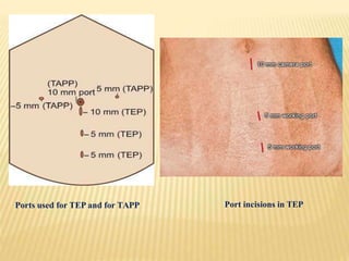 Ports used for TEP and for TAPP Port incisions in TEP
 
